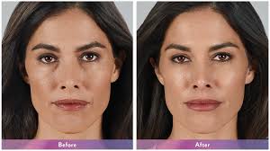 Juvederm Before and After Pictures O'Fallon, IL