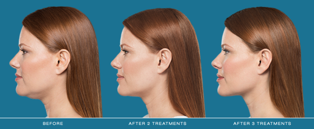 Kybella® Before and After Pictures O'Fallon, IL