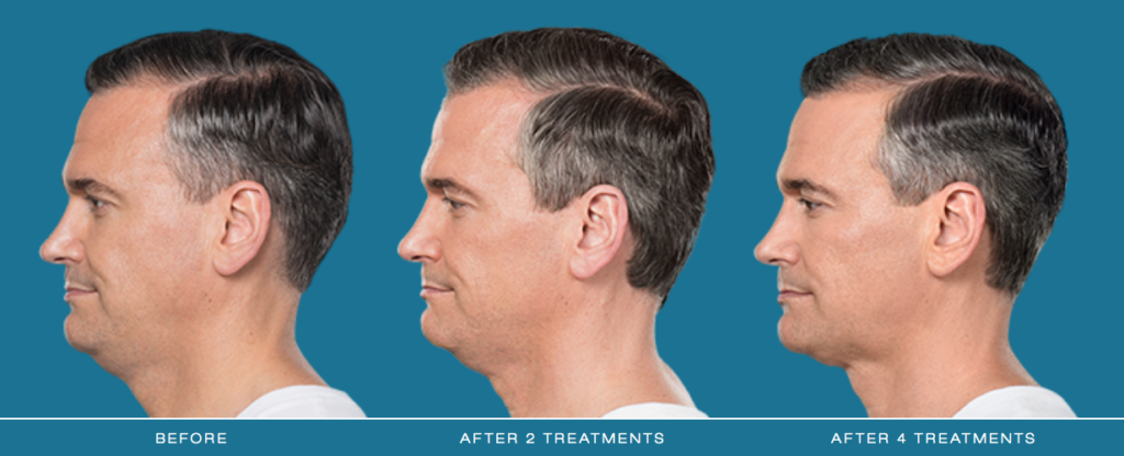 Kybella® Before and After Pictures O'Fallon, IL