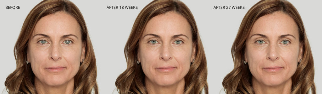 Sculptra® Before and After Pictures O'Fallon, IL