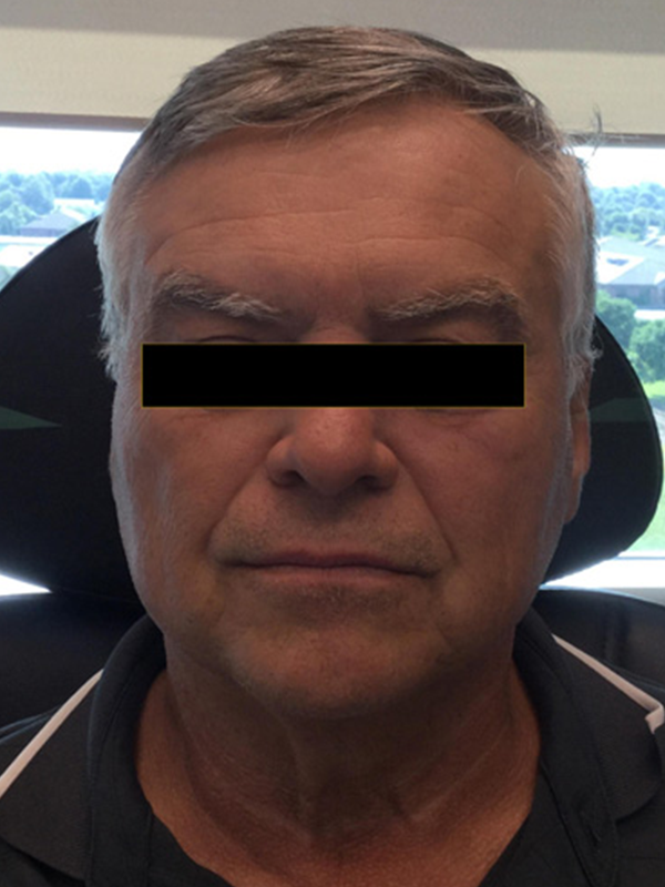 Botox® and Dysport® Before and After Pictures O'Fallon, IL Botox® and Dysport® Before and After Pictures O'Fallon, IL