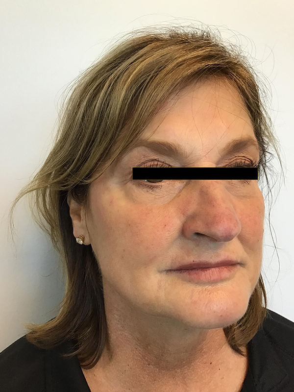 Lips Before and After Pictures O'Fallon, IL Lips Before and After Pictures O'Fallon, IL