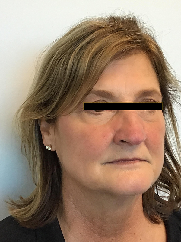 Lips Before and After Pictures O'Fallon, IL Lips Before and After Pictures O'Fallon, IL